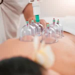 Cupping Therapy